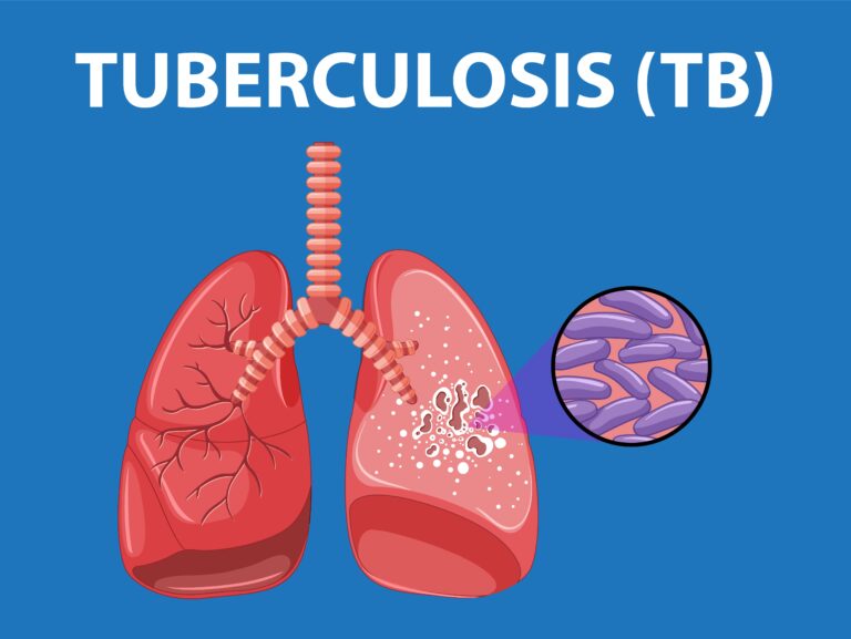 Hari Tuberkulosis Sedunia 2026: Menyalakan Harapan dan Aksi Nyata untuk Akhiri TB di Indonesia